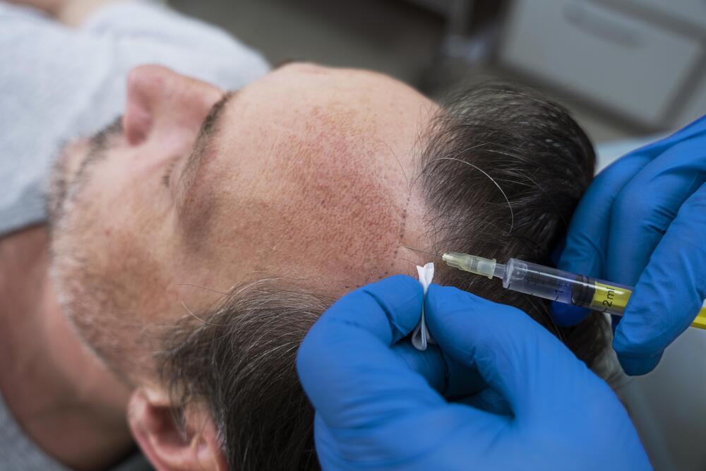 man getting hair loss treatment ()